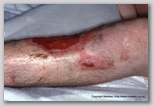 wound image